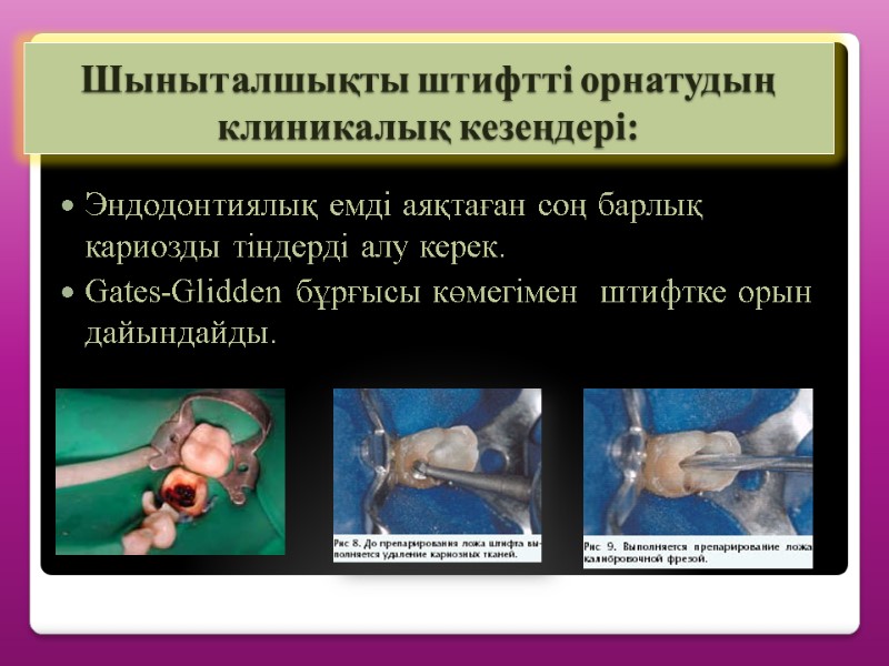 Шыныталшықты штифтті орнатудың клиникалық кезеңдері: Эндодонтиялық емді аяқтаған соң барлық кариозды тіндерді алу керек.